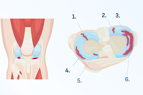 Dor interna no joelho e dor no joelho ao agachar - possíveis sinais de lesão do menisco A imagem mostra uma rotura do menisco do joelho: 1. Transversal, 2. Radial, 3. Horizontal, 4. Longitudinal